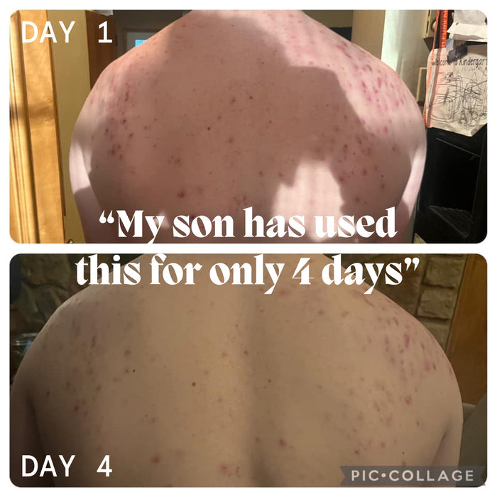 Before and after back photos, Day 1 to Day 4, with parent testimonial about the body acne balm