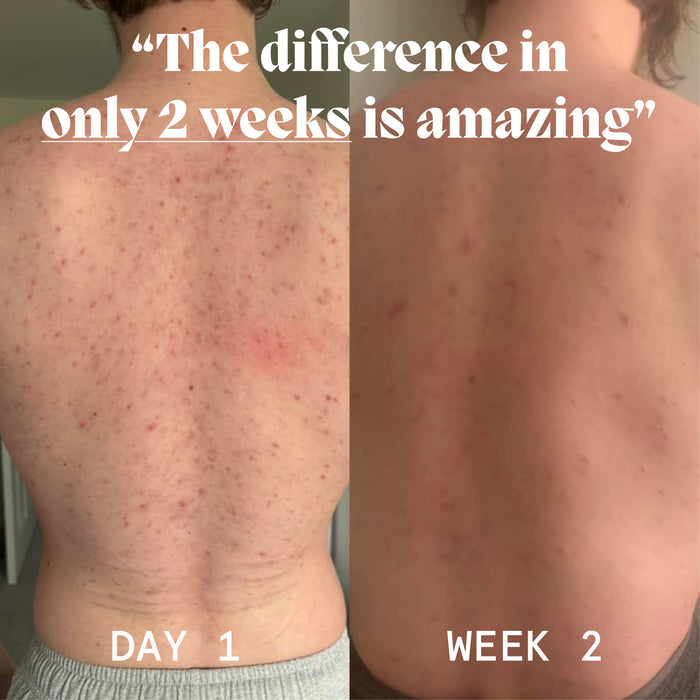 Before and after back photos, Day 1 to Week 2, showing clearer-looking skin with the body acne balm