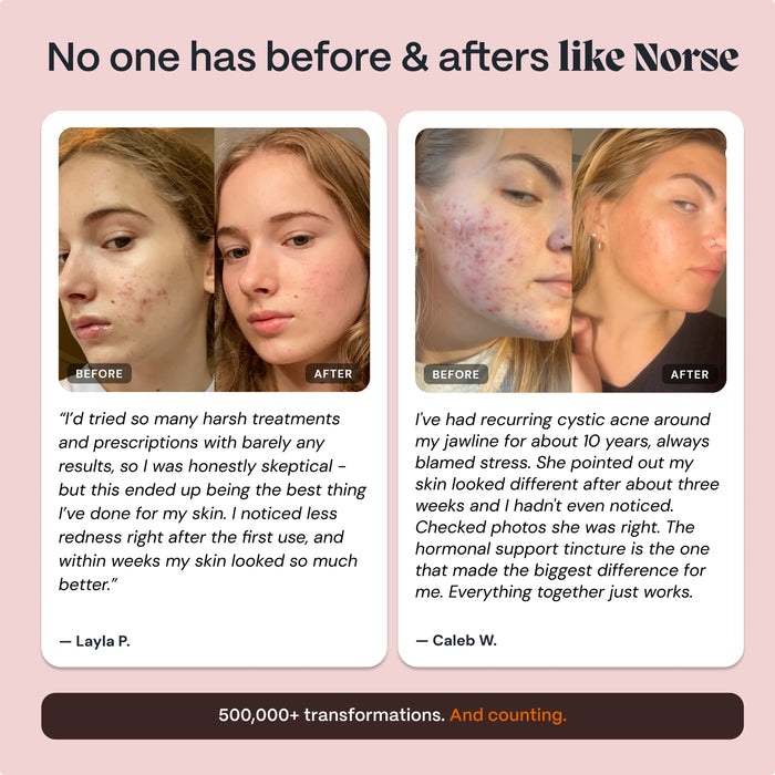 Complete Gut Repair & Hormonal Balance System for Female Acne-Prone Skin