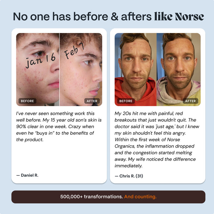 Complete Gut Repair & Hormonal Balance System for Male Acne-Prone Skin