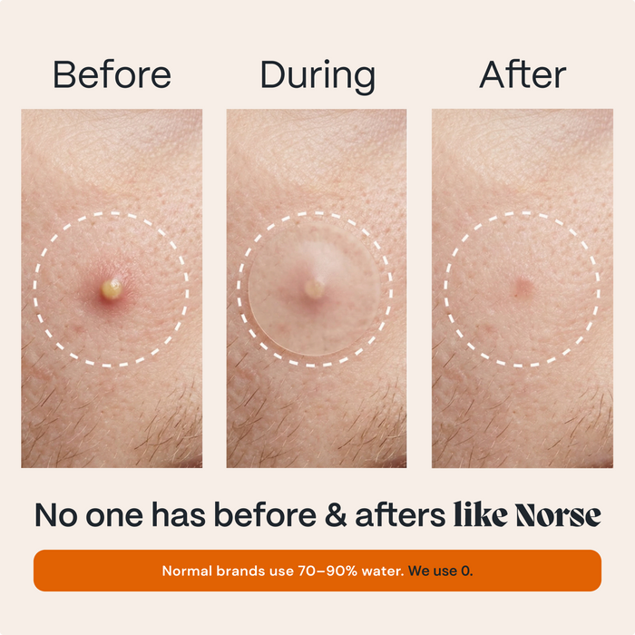 Before, during and after of a single pimple healing under a Norse Organics acne patch