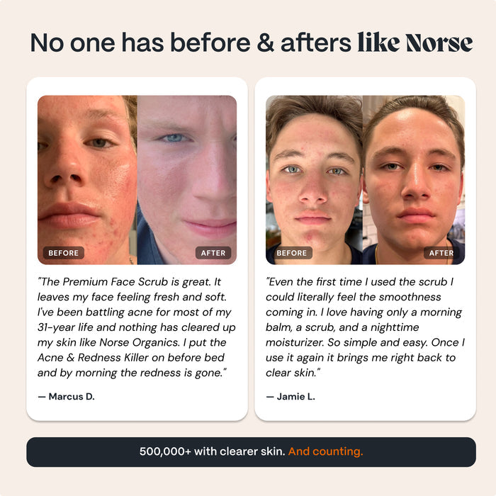 Scrub for Acne-Prone Skin